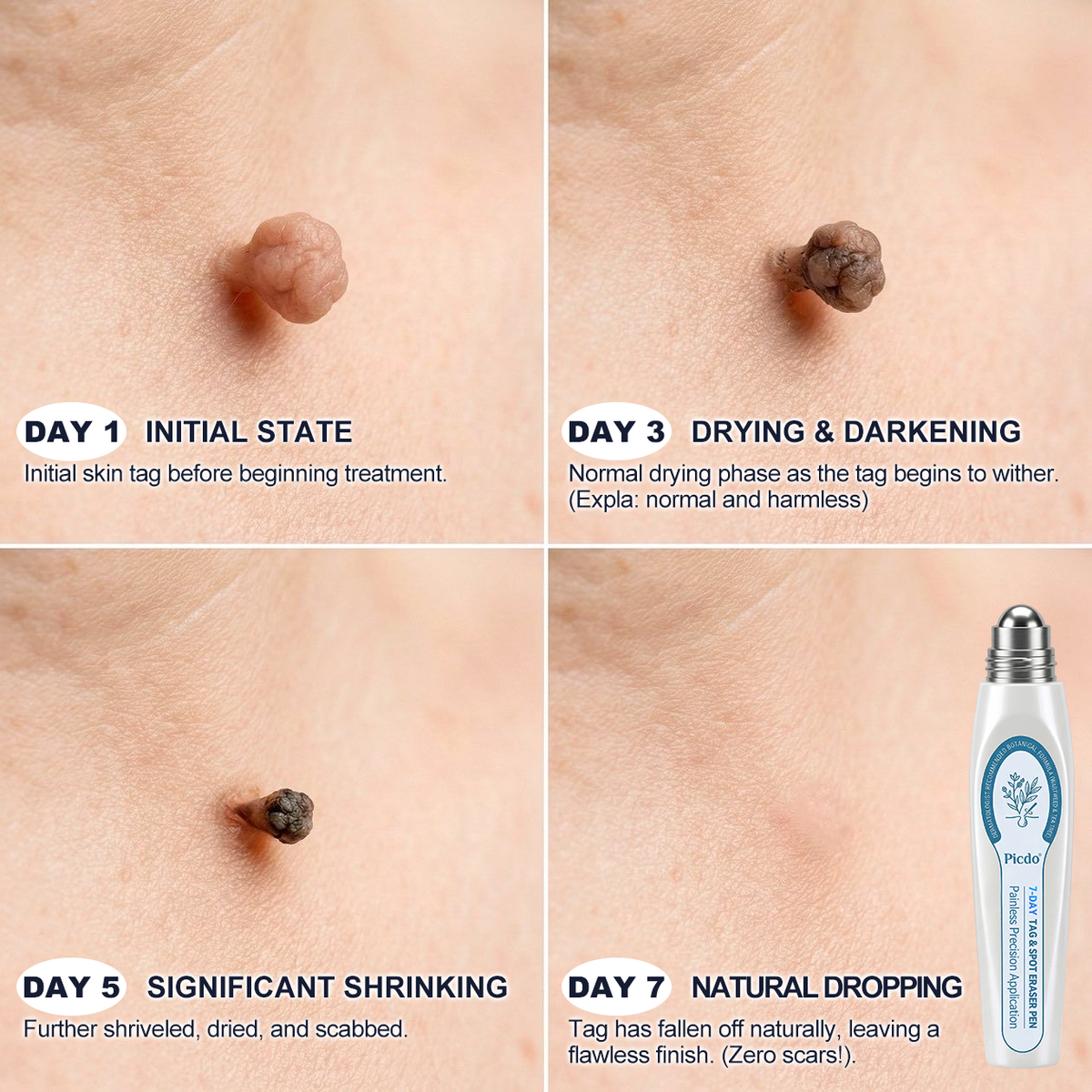 NuvoPaw® 7-𝐷𝑎𝑦 𝗧𝐚𝐠 & 𝗦𝗽𝐨𝐭 𝐄𝐫𝒂𝒔𝒆𝒓✅🎉(Zero Pain, Zero 𝐒𝐜𝐚𝒓𝒔 Rollerball)